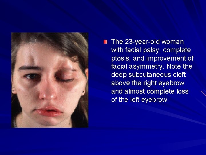 The 23 -year-old woman with facial palsy, complete ptosis, and improvement of facial asymmetry.