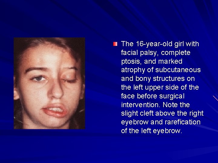 The 16 -year-old girl with facial palsy, complete ptosis, and marked atrophy of subcutaneous