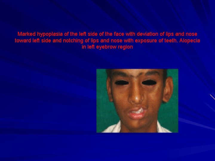 Marked hypoplasia of the left side of the face with deviation of lips and