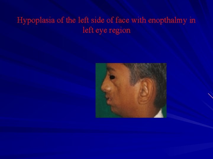 Hypoplasia of the left side of face with enopthalmy in left eye region 