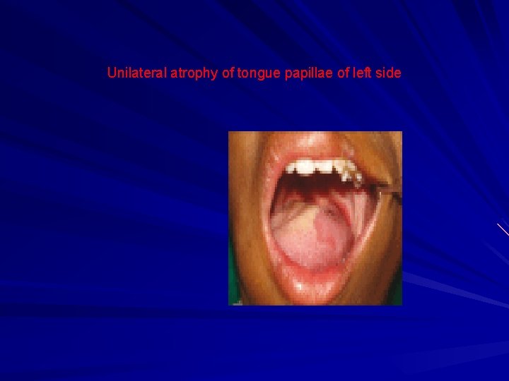 Unilateral atrophy of tongue papillae of left side 