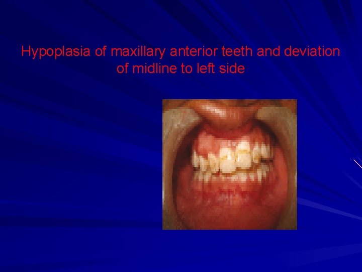 Hypoplasia of maxillary anterior teeth and deviation of midline to left side Hypoplasia of maxillary anterior teeth and deviation of midline to left side