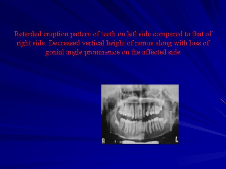 Retarded eruption pattern of teeth on left side compared to that of right side.