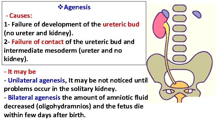 v. Agenesis - Causes: 1 - Failure of development of the ureteric bud (no