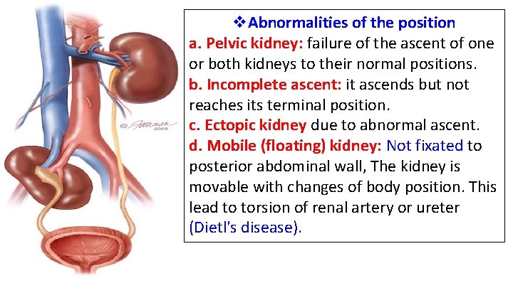 v. Abnormalities of the position a. Pelvic kidney: failure of the ascent of one