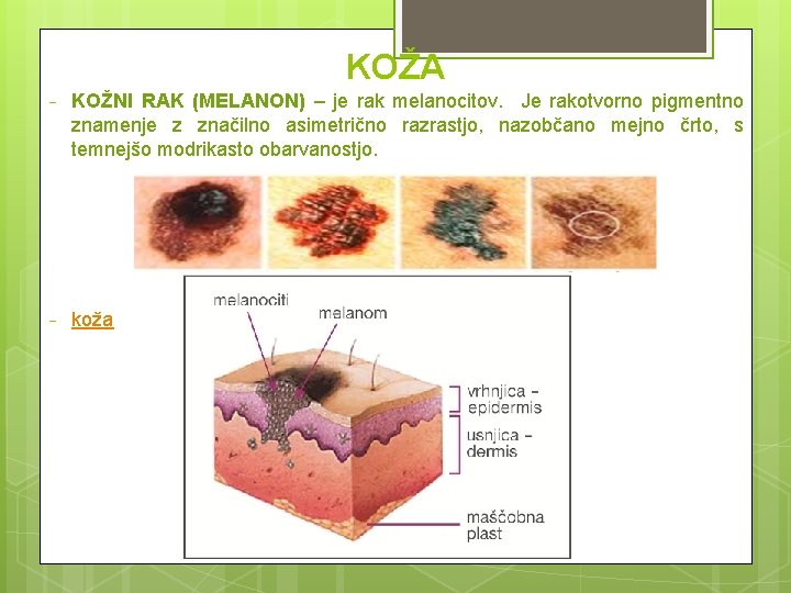 KOŽA − KOŽNI RAK (MELANON) – je rak melanocitov. Je rakotvorno pigmentno znamenje z