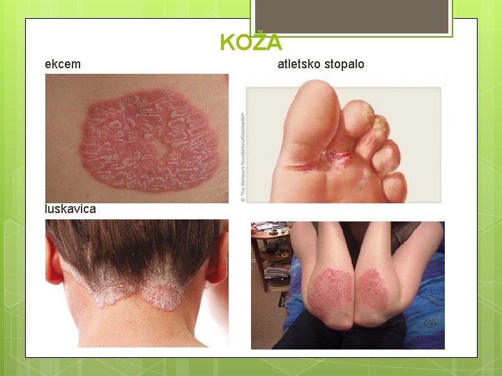 KOŽA ekcem luskavica atletsko stopalo 