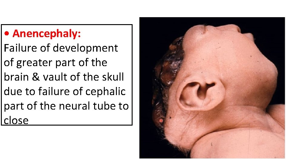  • Anencephaly: Failure of development of greater part of the brain & vault
