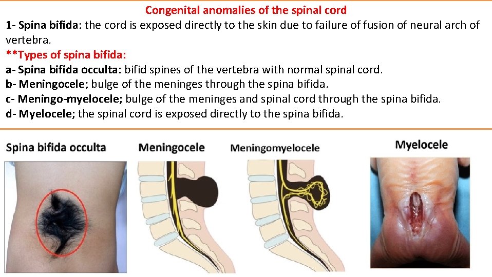 Congenital anomalies of the spinal cord 1 - Spina bifida: the cord is exposed