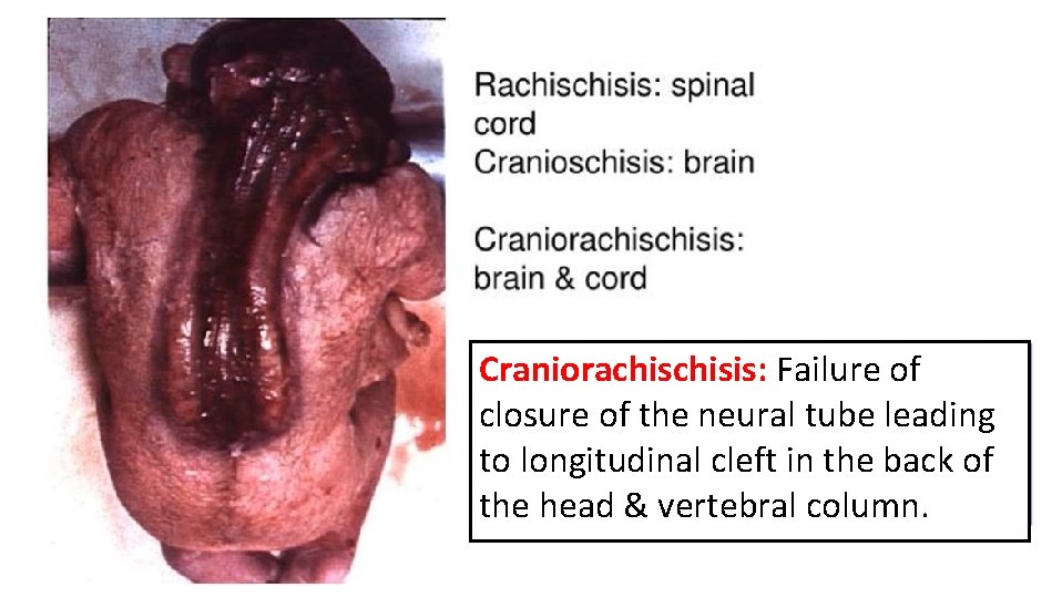 Craniorachisis: Failure of closure of the neural tube leading to longitudinal cleft in the