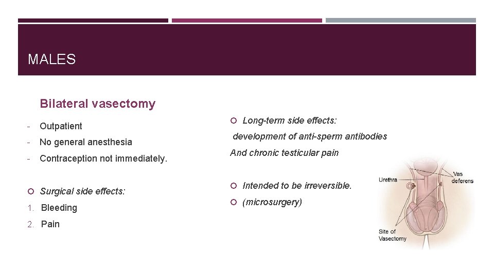 MALES Bilateral vasectomy - Outpatient - No general anesthesia - Contraception not immediately. Surgical