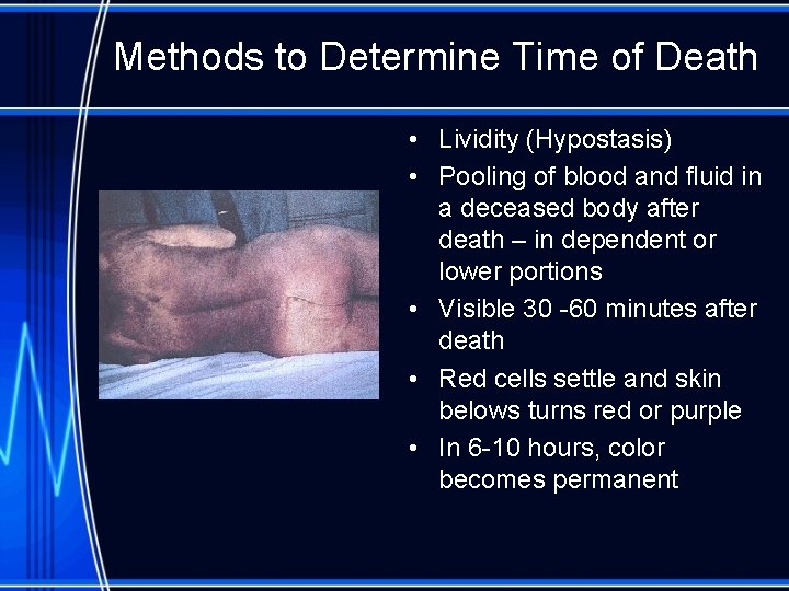 Methods to Determine Time of Death • Lividity (Hypostasis) • Pooling of blood and