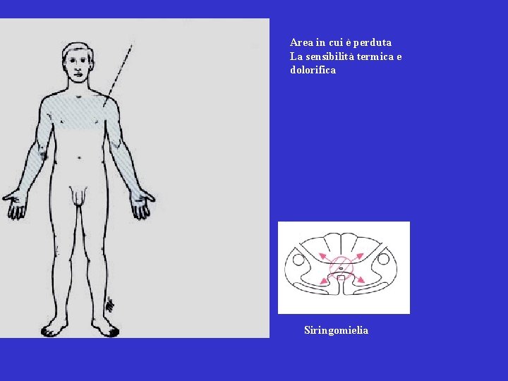 Area in cui è perduta La sensibilità termica e dolorifica Siringomielia 