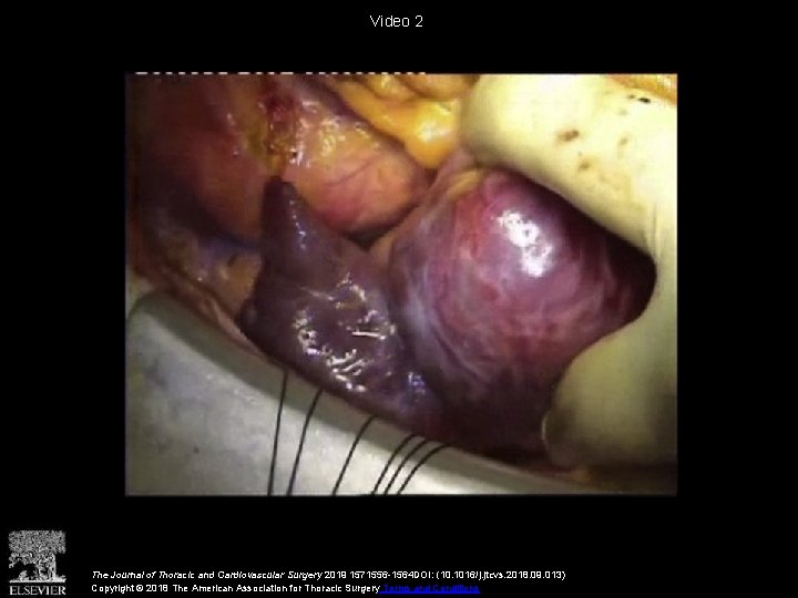 Video 2 The Journal of Thoracic and Cardiovascular Surgery 2019 1571556 -1564 DOI: (10.