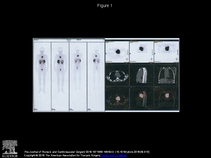 Figure 1 The Journal of Thoracic and Cardiovascular Surgery 2019 1571556 -1564 DOI: (10.