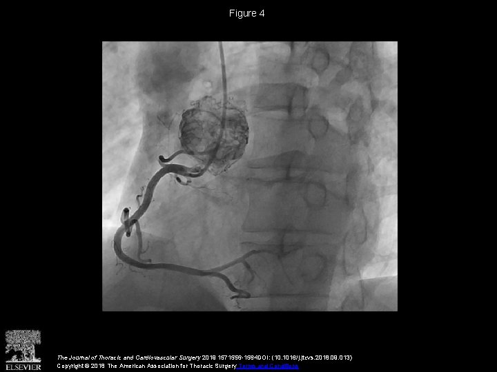 Figure 4 The Journal of Thoracic and Cardiovascular Surgery 2019 1571556 -1564 DOI: (10.