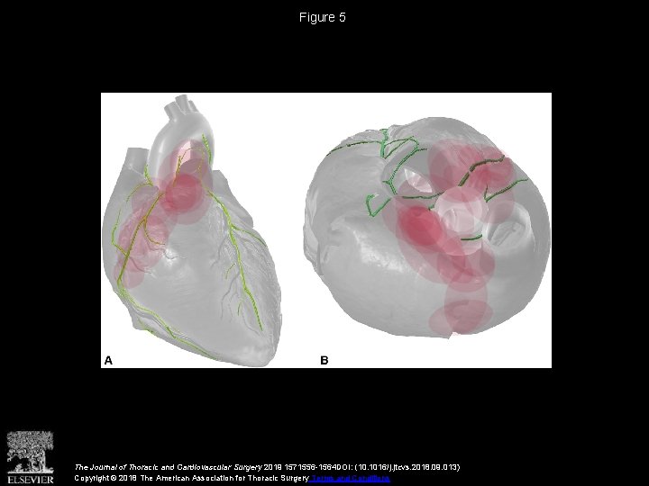 Figure 5 The Journal of Thoracic and Cardiovascular Surgery 2019 1571556 -1564 DOI: (10.