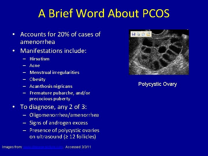 A Brief Word About PCOS • Accounts for 20% of cases of amenorrhea •