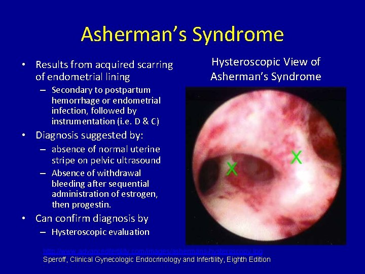 Asherman’s Syndrome • Results from acquired scarring of endometrial lining Hysteroscopic View of Asherman’s