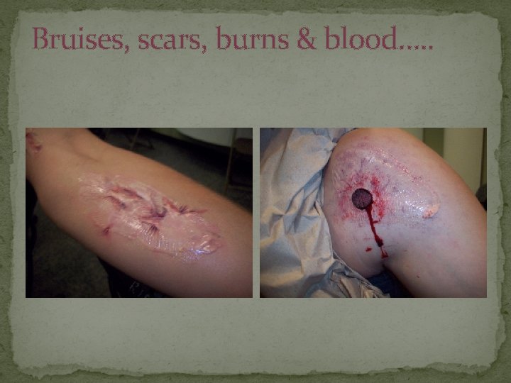 Bruises, scars, burns & blood…. . 