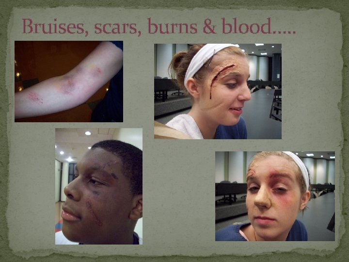 Bruises, scars, burns & blood…. . 