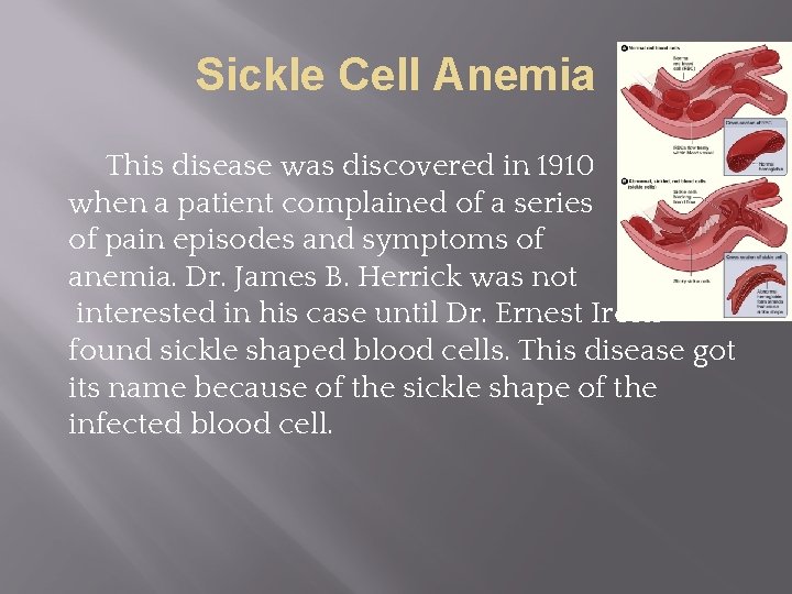 Sickle Cell Anemia This disease was discovered in 1910 when a patient complained of