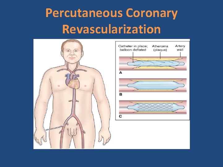 Percutaneous Coronary Revascularization 