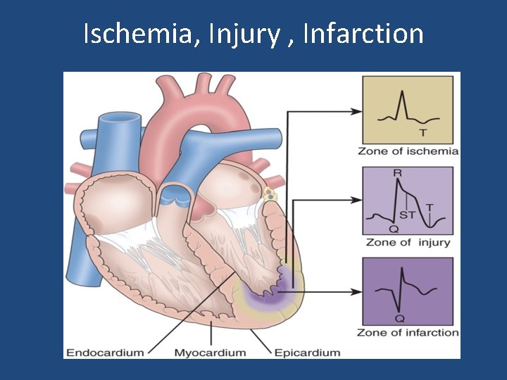 Ischemia, Injury , Infarction 