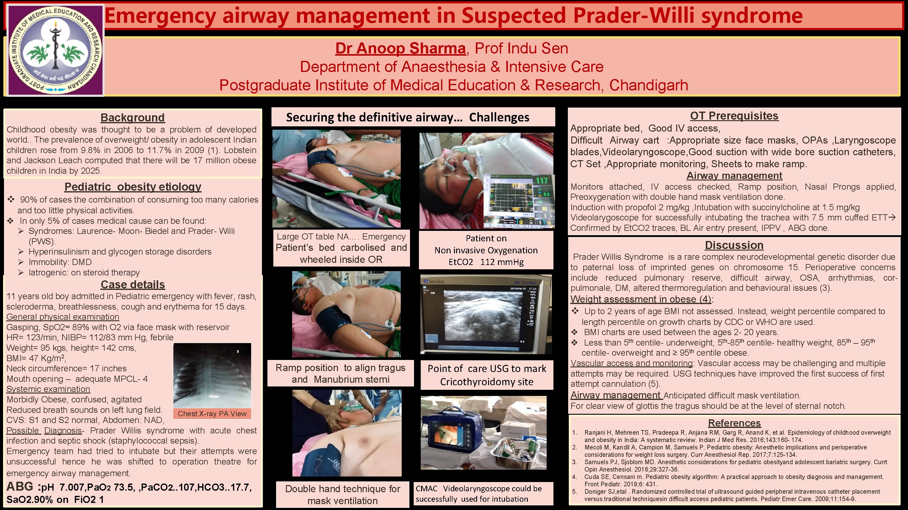 Emergency airway management in Suspected Prader-Willi syndrome Dr Anoop Sharma, Prof Indu Sen Department