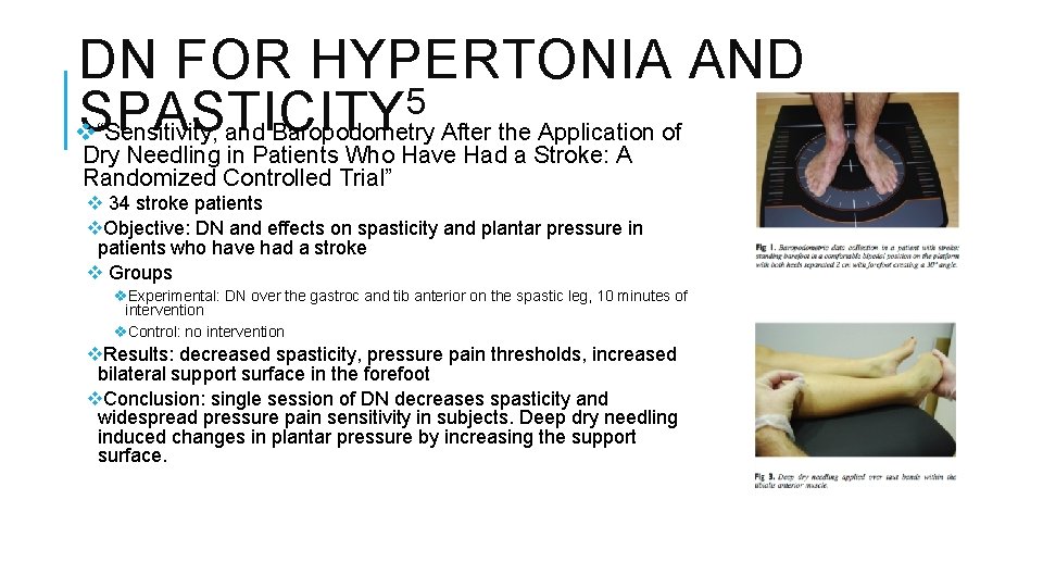 DN FOR HYPERTONIA AND 5 SPASTICITY v “Sensitivity, and Baropodometry After the Application of