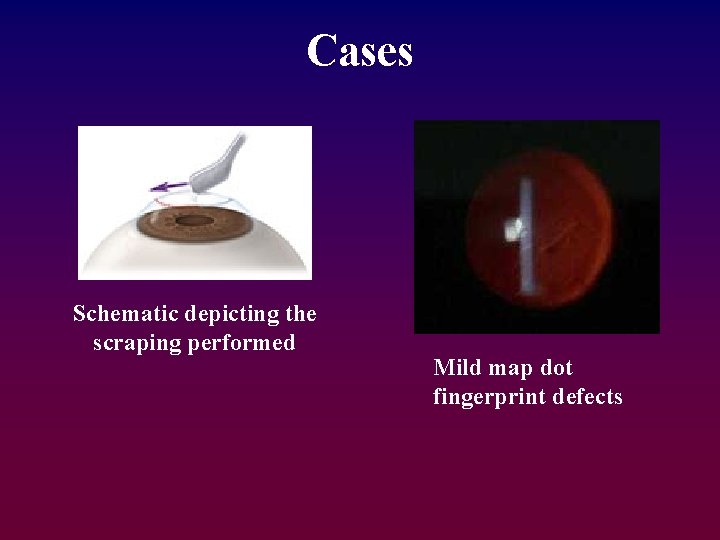 Cases Schematic depicting the scraping performed Mild map dot fingerprint defects 