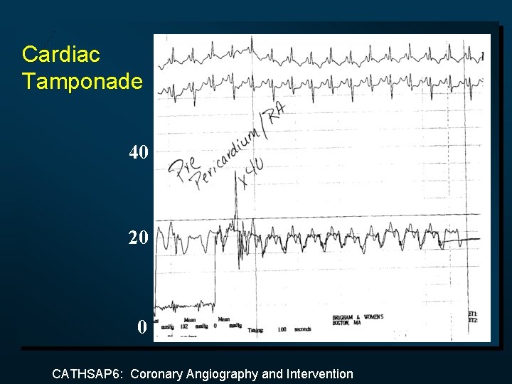 Cardiac Tamponade 40 20 0 CATHSAP 6: Coronary Angiography and Intervention 