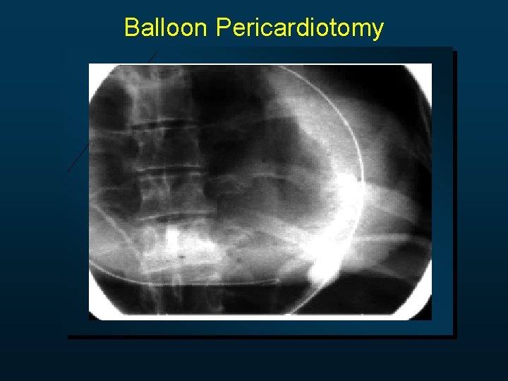 Balloon Pericardiotomy 