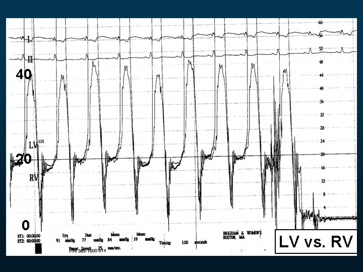 40 20 0 LV vs. RV 