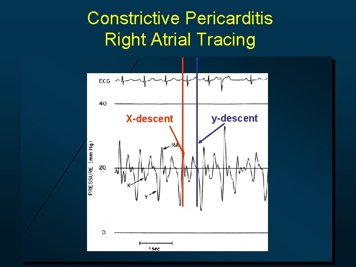 Constrictive Pericarditis Right Atrial Tracing X-descent y-descent 