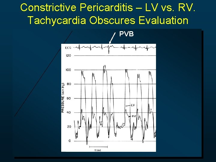 Constrictive Pericarditis – LV vs. RV. Tachycardia Obscures Evaluation PVB 