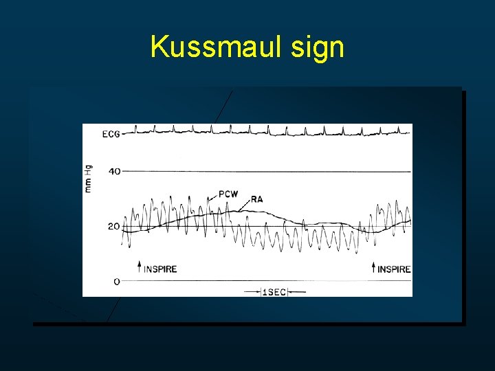 Kussmaul sign 