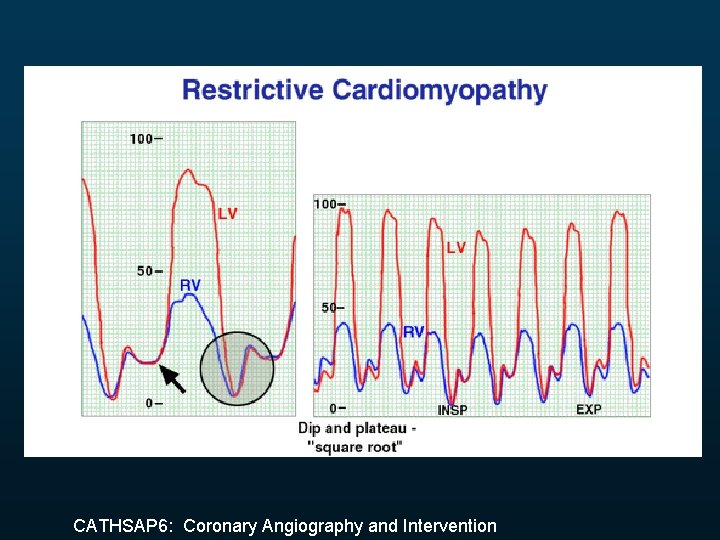 CATHSAP 6: Coronary Angiography and Intervention 