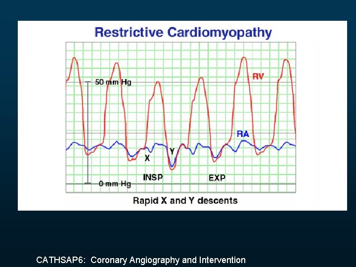 CATHSAP 6: Coronary Angiography and Intervention 