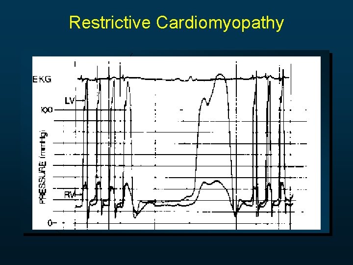 Restrictive Cardiomyopathy 