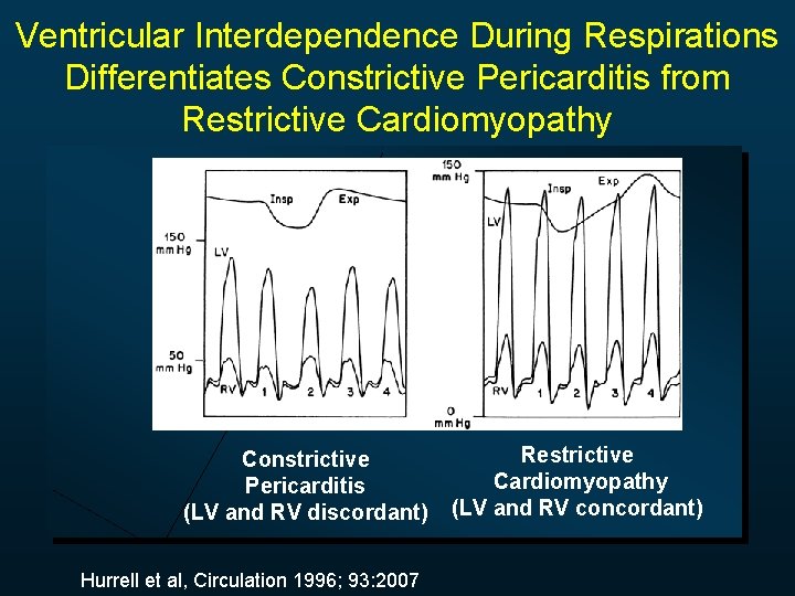 Ventricular Interdependence During Respirations Differentiates Constrictive Pericarditis from Restrictive Cardiomyopathy Constrictive Pericarditis (LV and