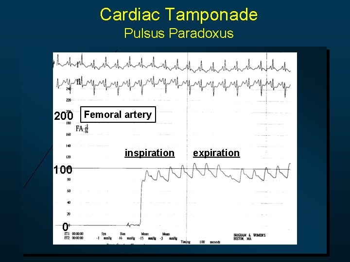 Cardiac Tamponade Pulsus Paradoxus 200 Femoral artery inspiration 100 0 expiration 