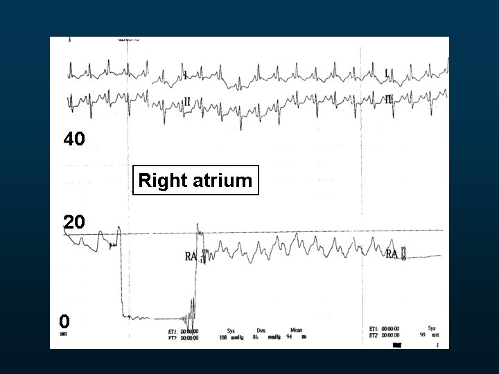 40 Right atrium 20 0 