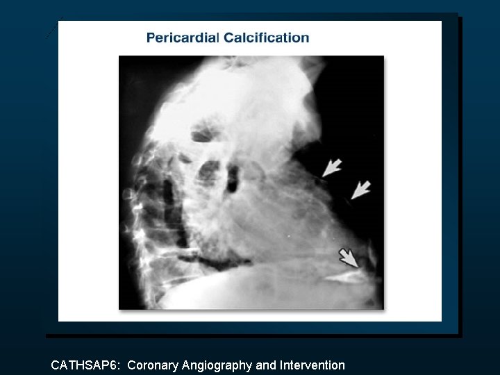 CATHSAP 6: Coronary Angiography and Intervention 