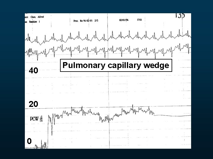 40 20 0 Pulmonary capillary wedge 