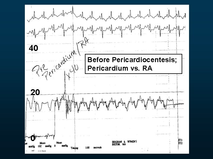 40 Before Pericardiocentesis; Pericardium vs. RA 20 0 