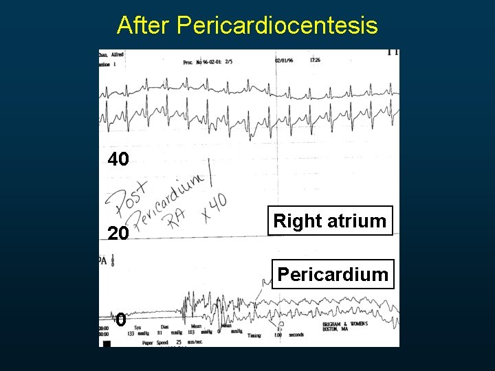After Pericardiocentesis 40 20 Right atrium Pericardium 0 