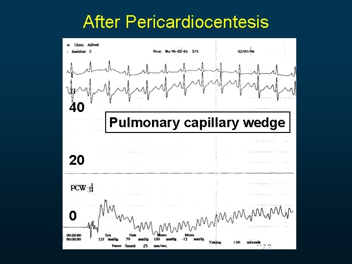 After Pericardiocentesis 40 20 0 Pulmonary capillary wedge 