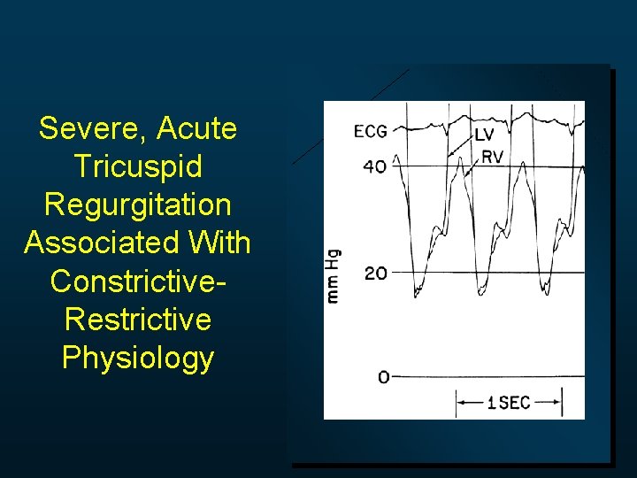 Severe, Acute Tricuspid Regurgitation Associated With Constrictive. Restrictive Physiology 