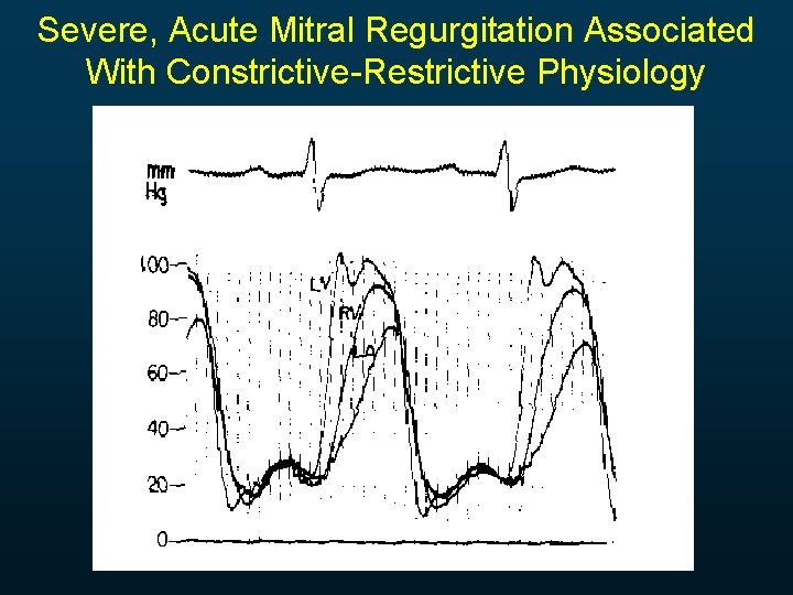 Severe, Acute Mitral Regurgitation Associated With Constrictive-Restrictive Physiology 